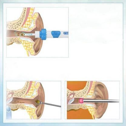 Strong Ear Aspiratore di Cerume Professionale senza dolore, per bambini e adulti